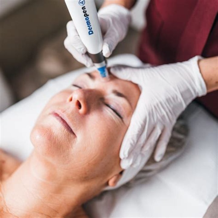 derma needling