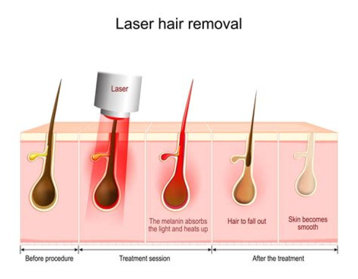 Does laser hair removal work
