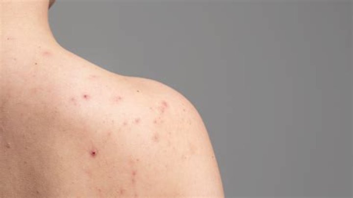 shoulder acne
